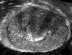 Conventional ultrasound image